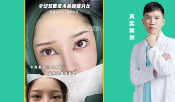 全切双眼皮术后即可对比
