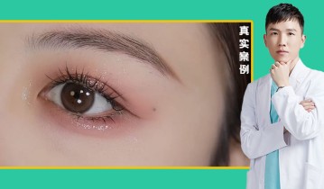 周鸿庆医生-眼综合双眼皮效果