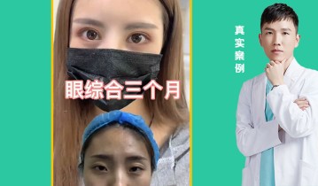 眼综合3个月效果