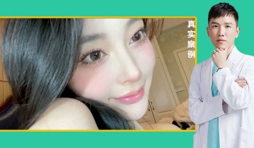 周鸿庆医生-黄金媚眼重睑术效果